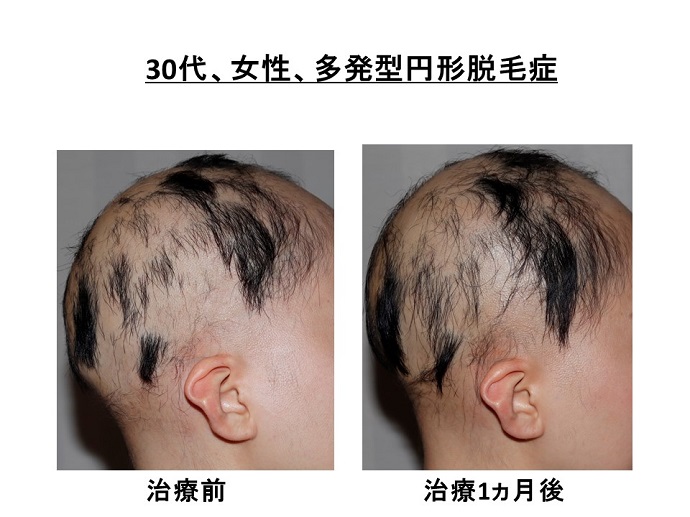 円形脱毛症　病院